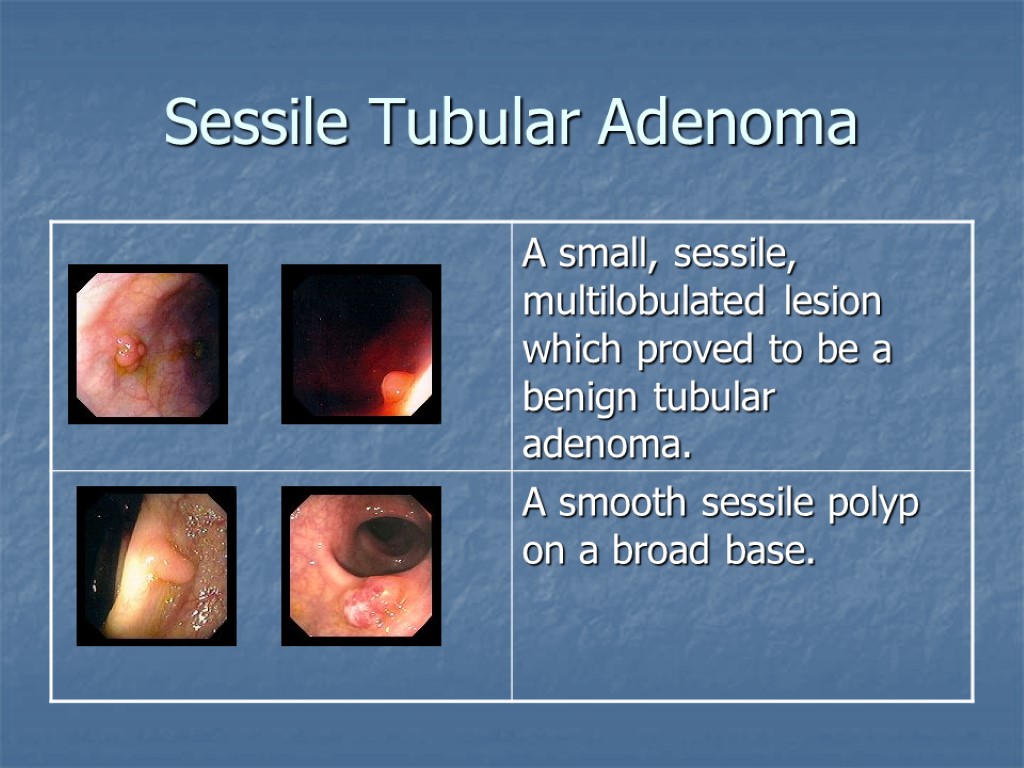 Sessile Tubular Adenoma